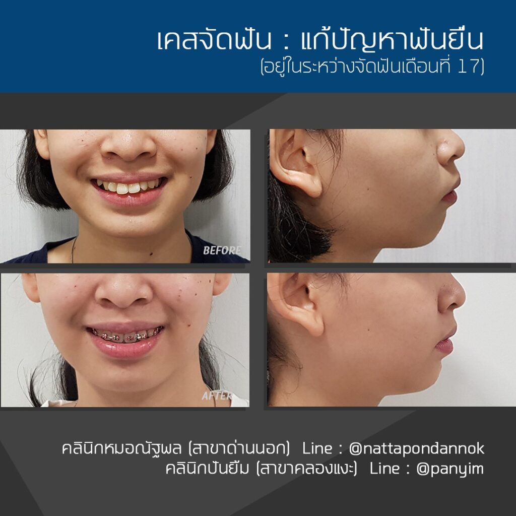 รีวิวจัดฟัน
