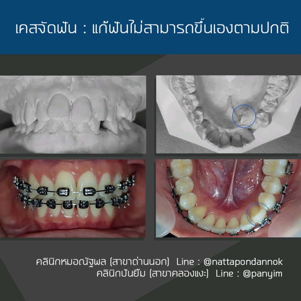 รีวิวจัดฟัน