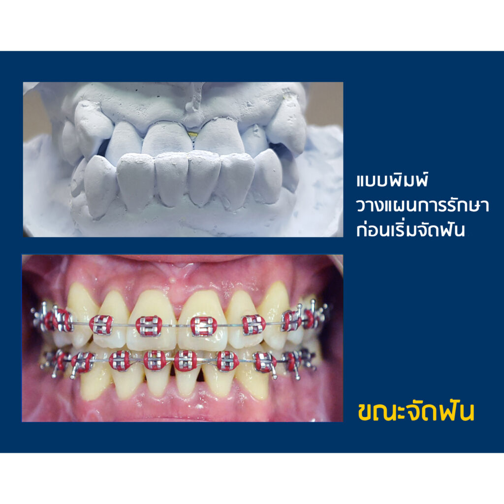 รีวิวจัดฟัน